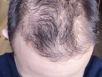 cuir chevelu dermo-ness dermopigmentation dégarni la valette du var