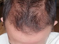 dermo-ness-dermopigmentationmanque cheveux la valette du var