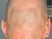 dermo-ness dermopigmentation chauve la valette du var