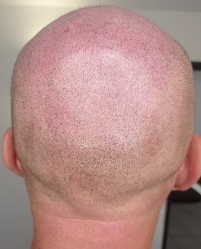 trichopigmentation dermopigmentation la valette du var