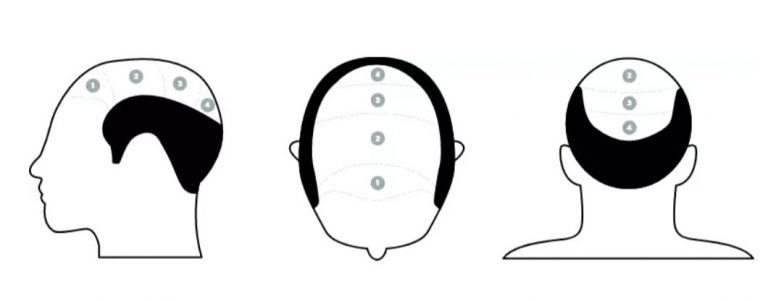 dermo-ness-dermopigmentation-scalp-valette-var