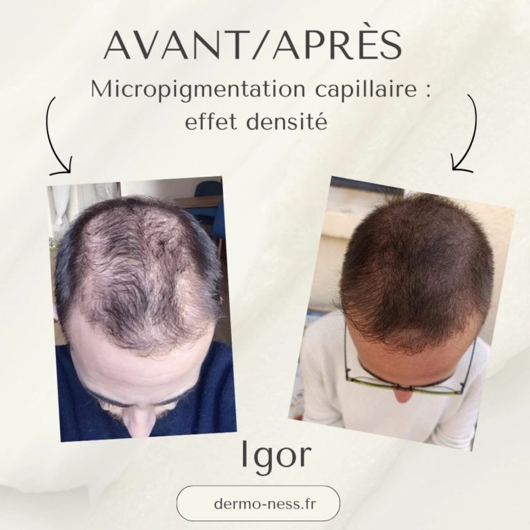 Dermo-ness dermopigmentation densité capillaire La Valette du Var Toulon pas cher