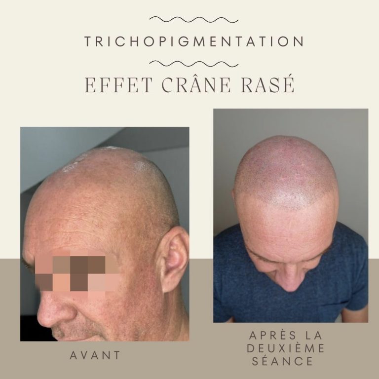 Trichopigmentation effet crane rase Dermo-Ness La Valette du Var Toulon