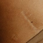 dermo-ness la valette-toulon-réparation-cicatrices